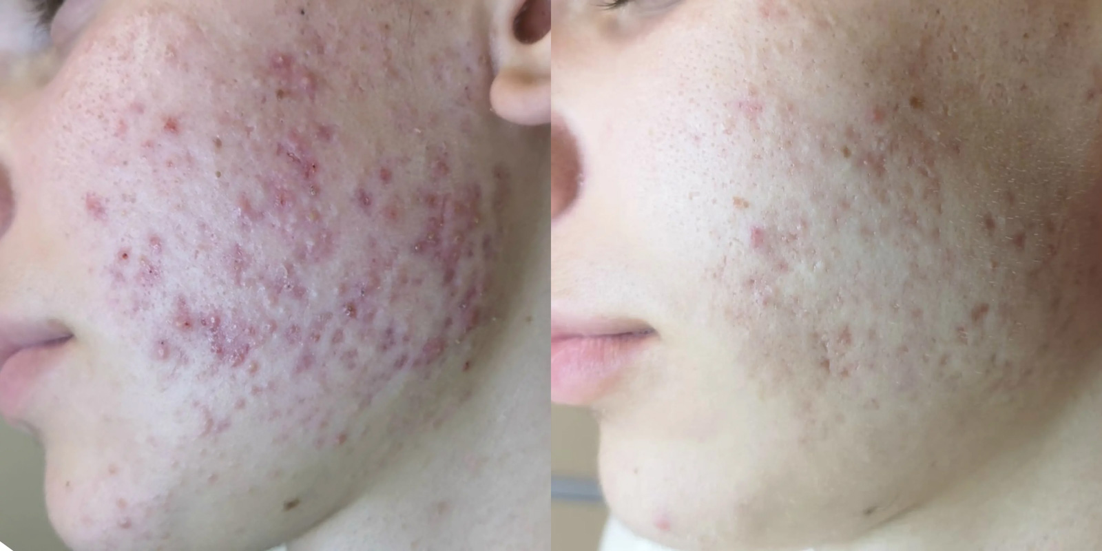 Výsledky dermatologického BioRepeel pred a po ošetrení -Príklad č. 1